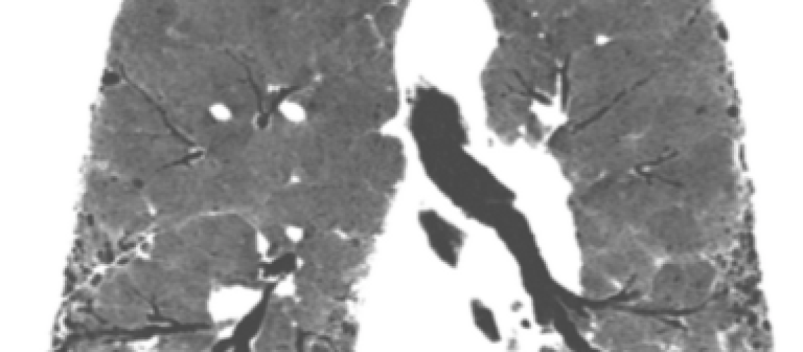 fibrosis pulmonar idiopatica