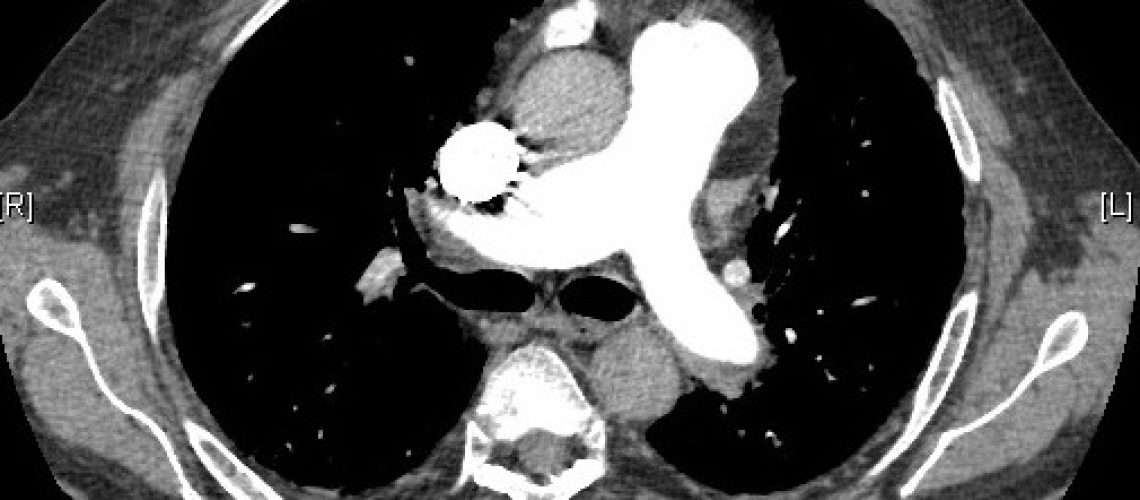 HIPERTENSION PULMONAR
