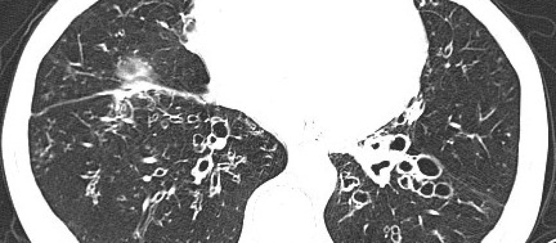 bronquiectasias