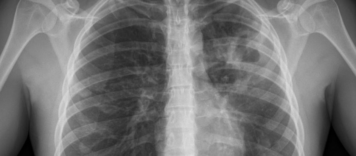 tuberculosis